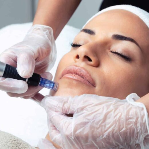 Microneedling