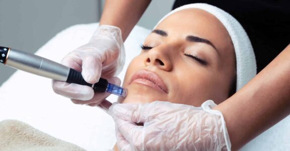 Microneedling