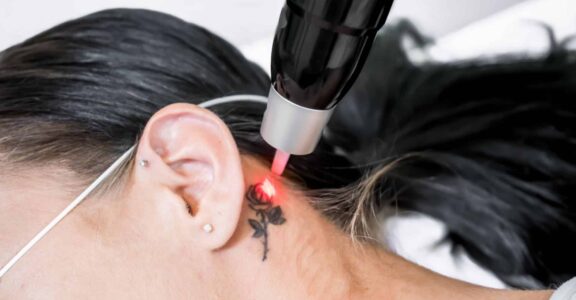Laser de détatouage
