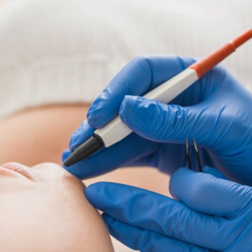 APILUS by XCell PRO &#8211; épilation haute fréquence